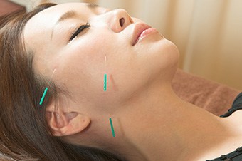Acupuncture in Washington D.C. and Chinese Medicine. Photo of woman's face with acupuncture needles.