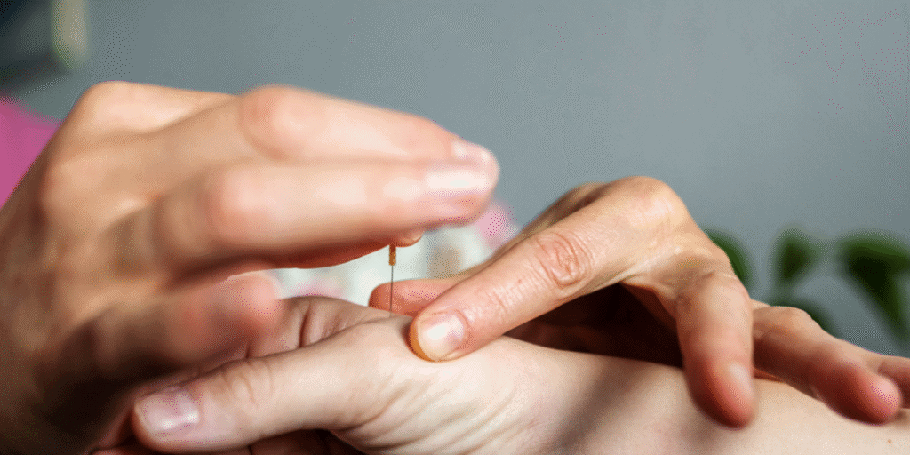 Acupuncture LR4 hand needling